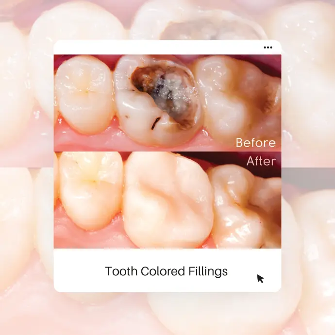 Tooth Colored Fillings